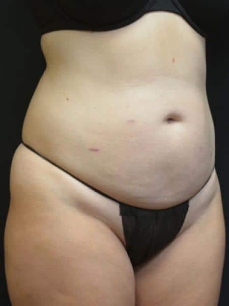 Before Image: Liposuction - right-front-oblique