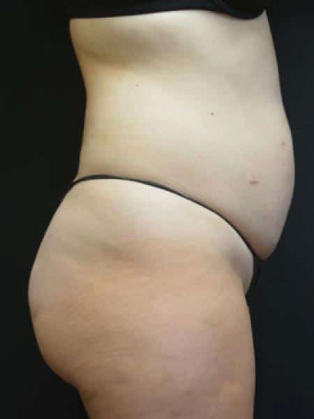 Before Image: Liposuction - right-side
