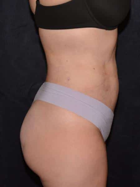 After Image: Liposuction - right-side