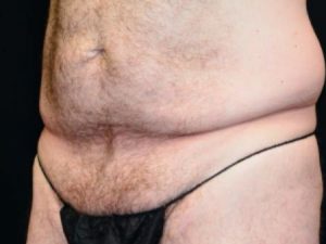 Body Contouring After Weight Loss Surgery