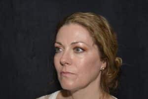 Neck lift