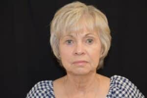 Naturale Facelift