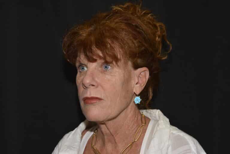 Before Image: Naturale Face Neck lift - front