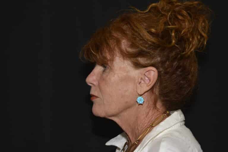 Before Image: Naturale Face Neck lift - front