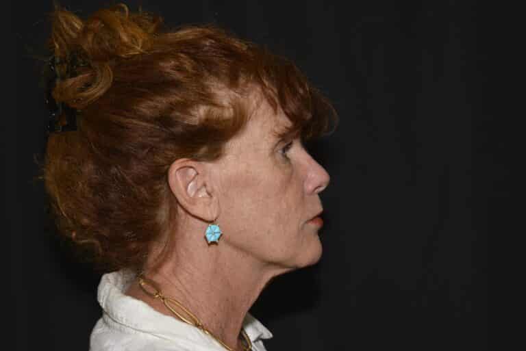 Before Image: Naturale Face Neck lift - front