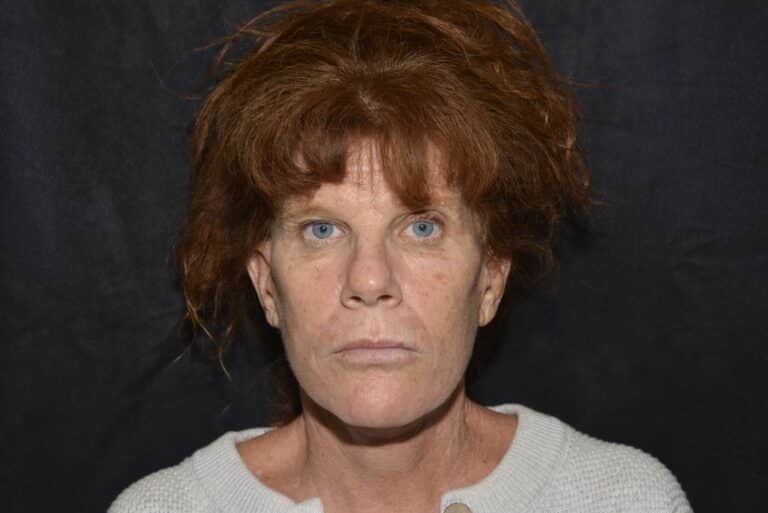 Before Image: Naturale Face Neck lift - front