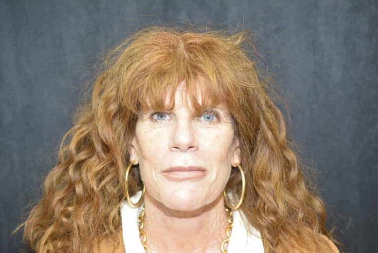 After Image: Naturale Face Neck lift - front
