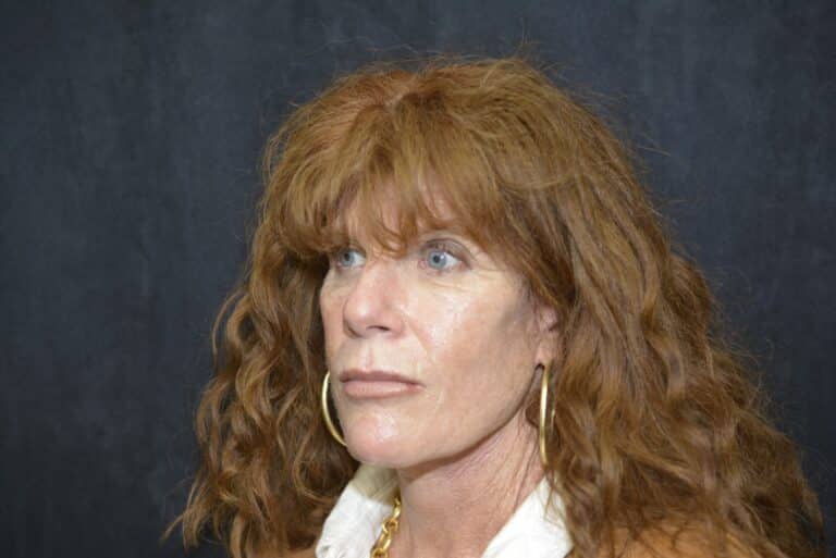 After Image: Naturale Face Neck lift - front