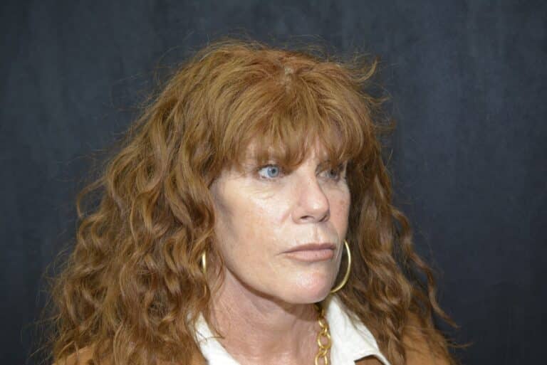After Image: Naturale Face Neck lift - front