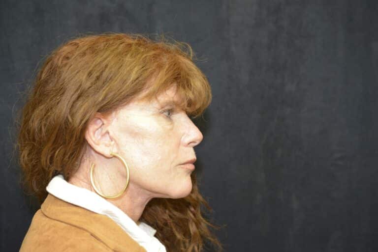After Image: Naturale Face Neck lift - front