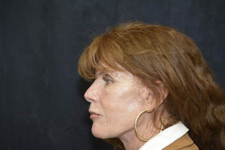 After Image: Naturale Face Neck lift - front