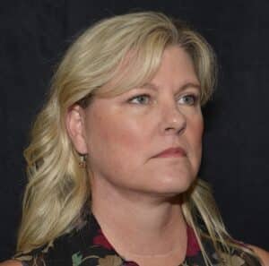 Naturale face neck lift with lip lift