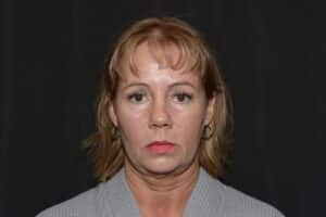 Naturale face-neck lift