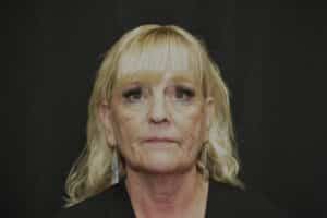 Naturale face-neck lift
