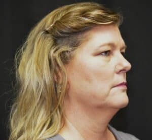 Naturale face neck lift with lip lift