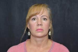 Naturale face-neck lift
