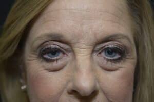 Before Image: Lower blepharoplasty