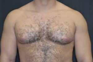 Before Image: Correction of Gynecomastia