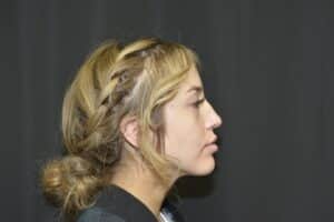 Before Image: Filler to the nose Restylane Defyne