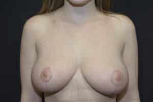 After Image: Breast reduction