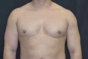After Image: Correction of Gynecomastia