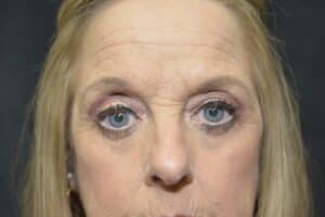 After Image: Lower blepharoplasty