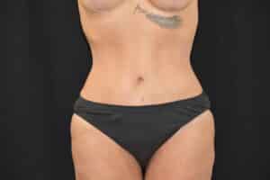 After Image: Tummy Tuck with Liposuction