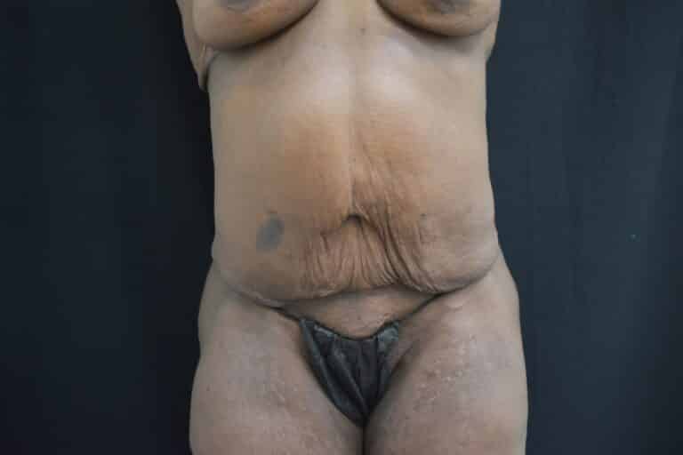 Before Image: Post Weight loss and body contouring - front