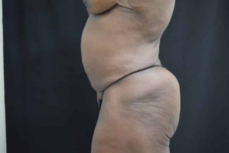 Before Image: Post Weight loss and body contouring - 