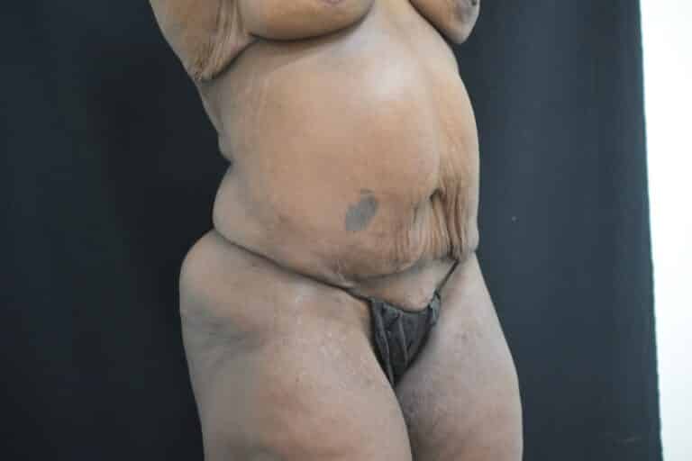 Before Image: Post Weight loss and body contouring - 