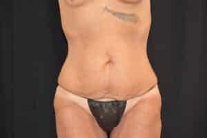 Before Image: Tummy Tuck with Liposuction