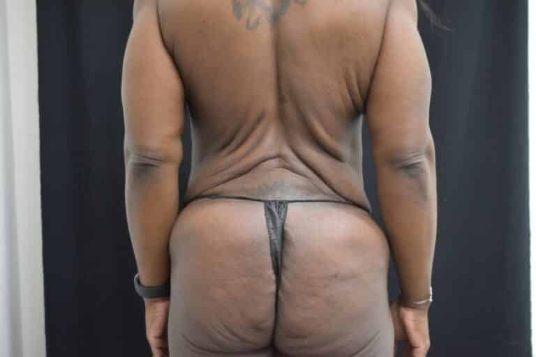 Before Image: Post Weight loss and body contouring - 