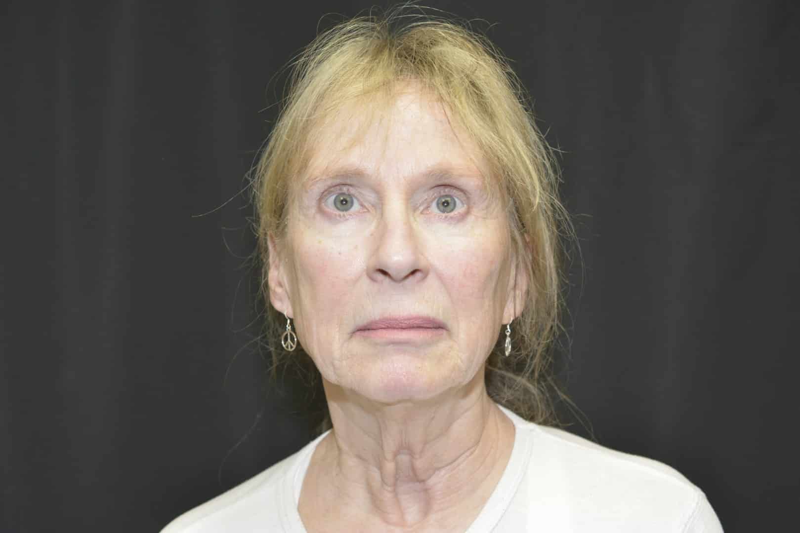 Before Image: Naturale Facelift - front