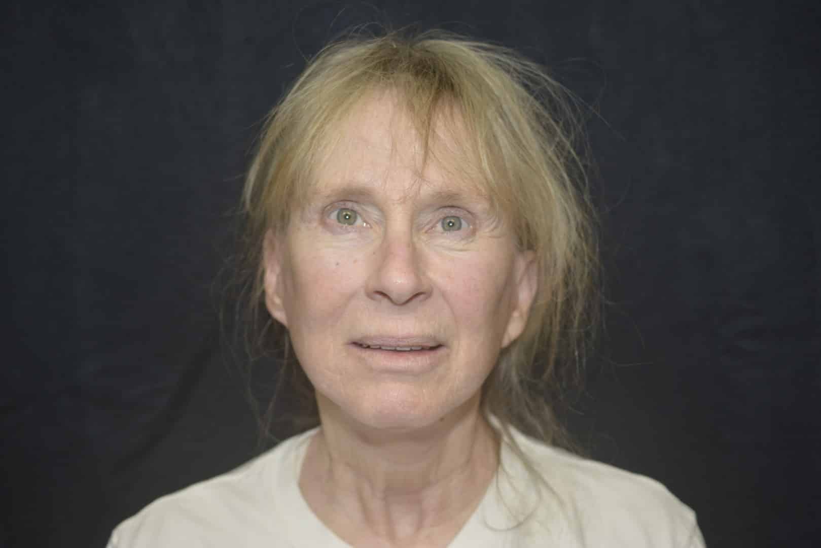 After Image: Naturale Facelift - front