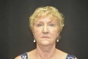 Before Image: Naturale Facelift