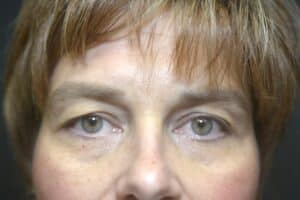 Before Image: Upper Blepharoplasty