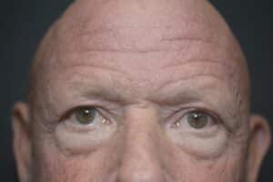Before Image: Lower Blepharoplasty