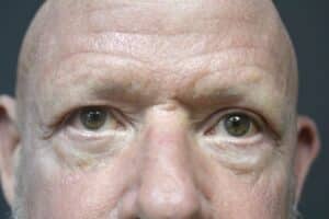After Image: Lower Blepharoplasty
