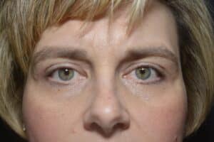 After Image: Upper Blepharoplasty