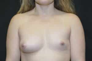 Before Image: Breast Enlargement