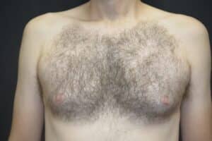 Before Image: Male Breast Surgery