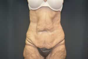 Before Image: Tummy Tuck