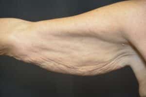 Before Image: Arm Lift