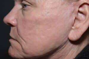 After Image: CO2 laser