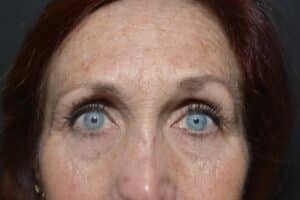 Before Image: CO2 laser