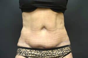 After Image: Tummy Tuck