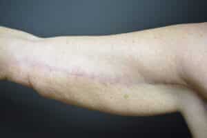 After Image: Arm Lift