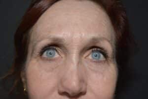 After Image: CO2 laser