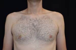 After Image: Male Breast Surgery