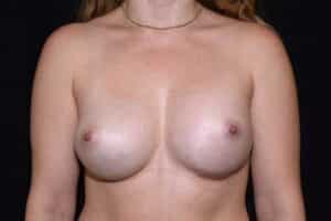 After Image: Breast Enlargement